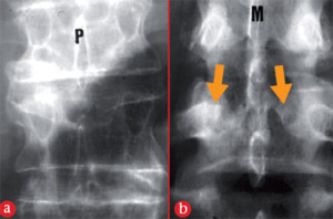 Signe du puzzle ostéoporose